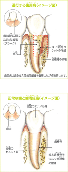 歯周病イメージ図