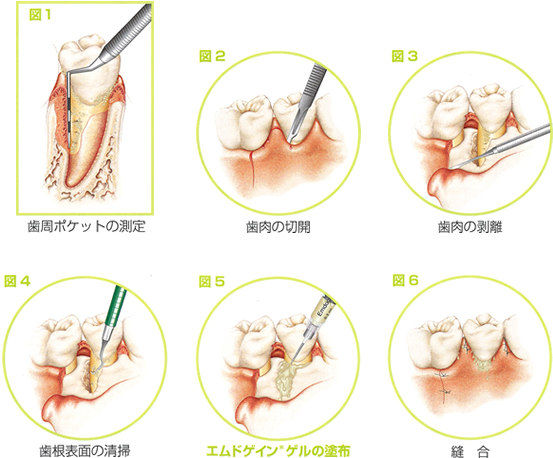 歯周病イメージ図